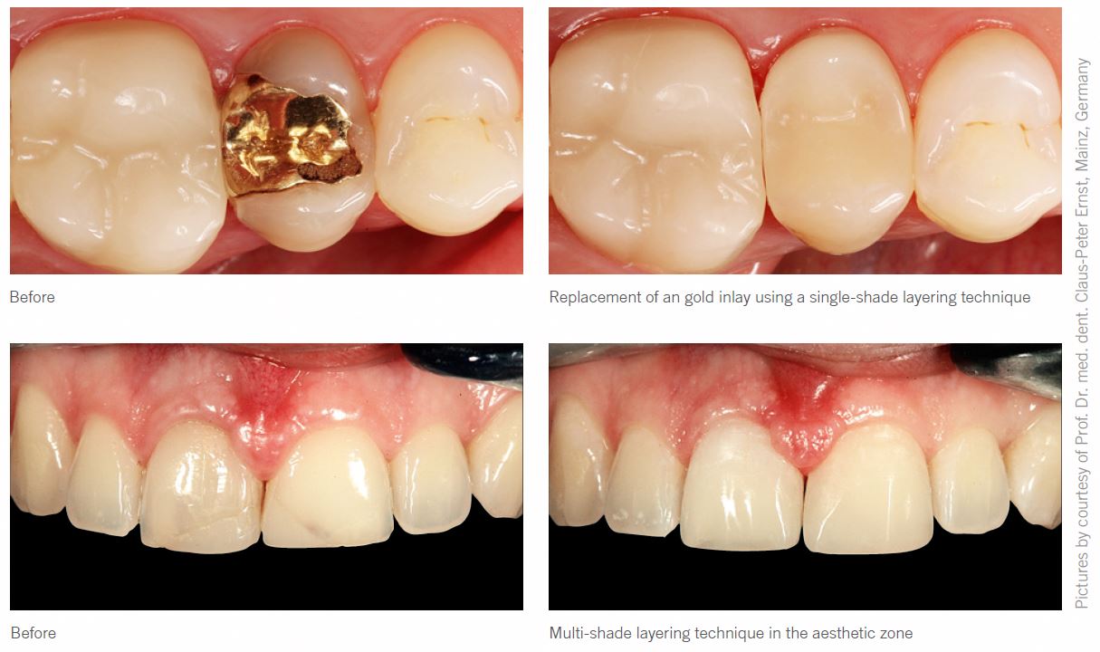  کامپوزیت توپاز کاریزما Kulzer -Charisma Topaz Composite